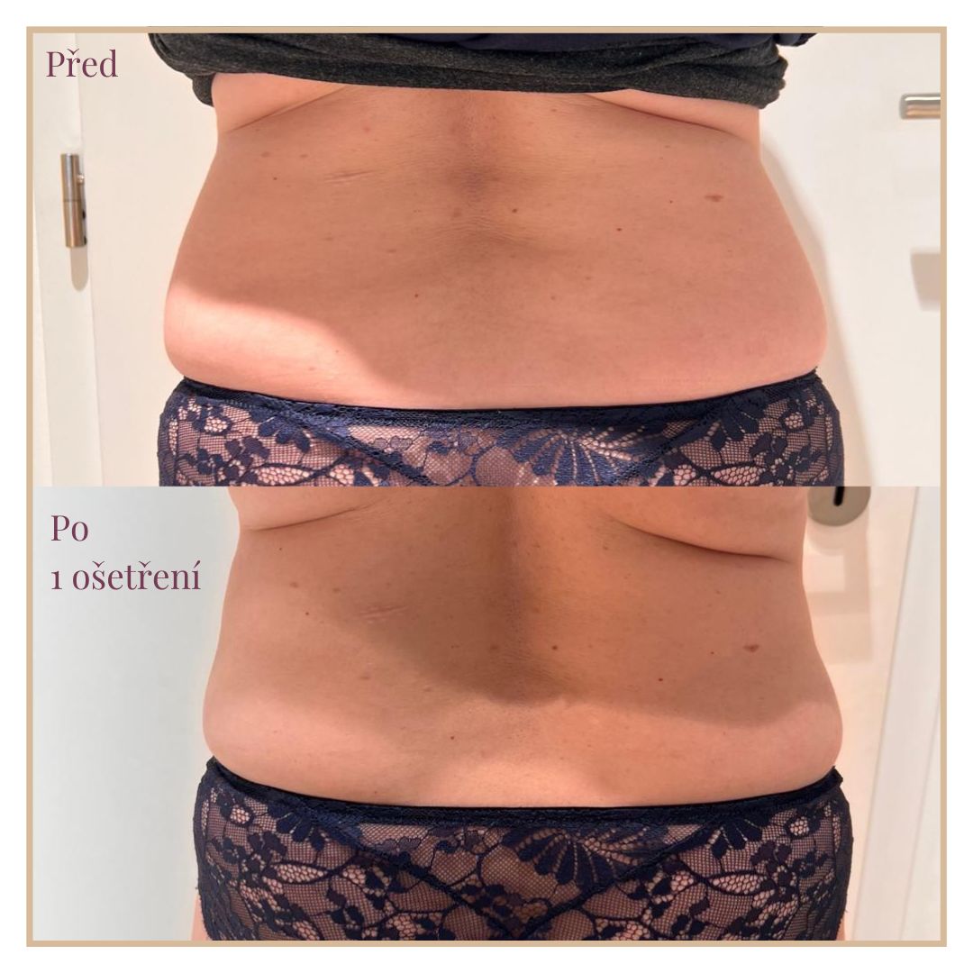CoolSculpting for Love Handles (+ Before and After)