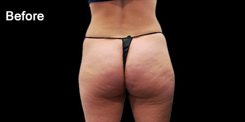 Buttock-case-treatment-by-Dr-LEAH_1_Before.png