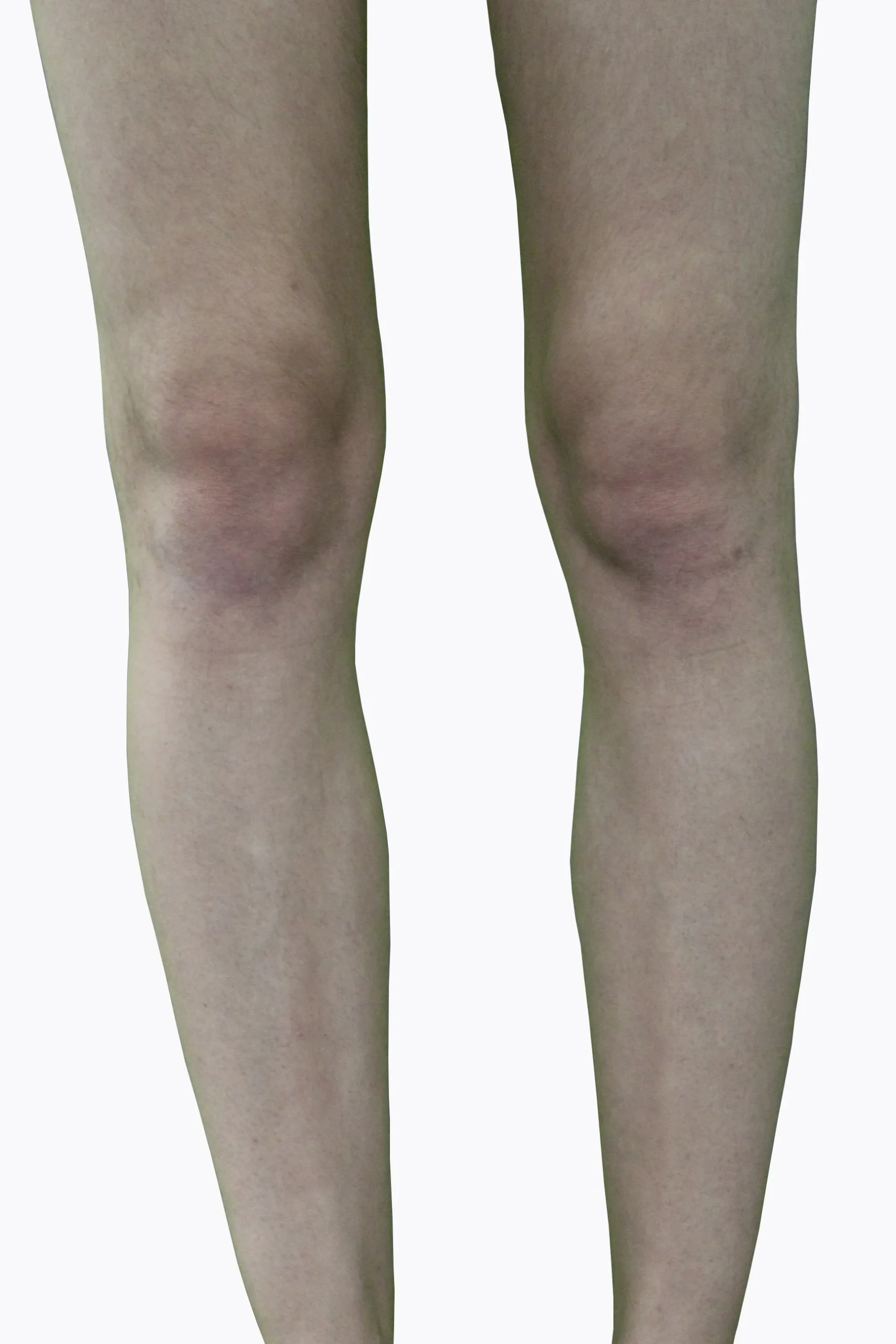 Legs_After-5-scaled.webp Legs_After-5-scaled.webp