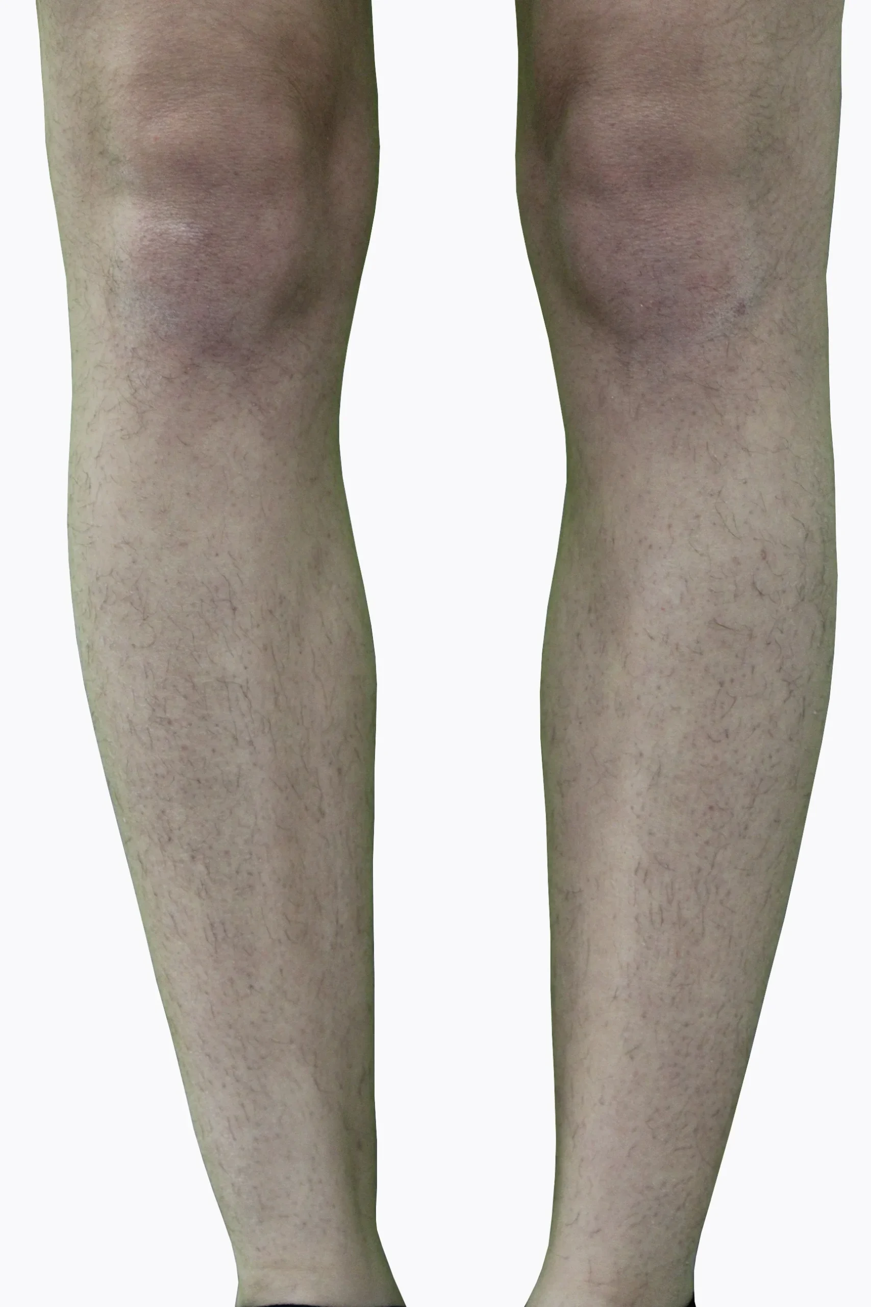 Legs_Before-5-scaled.webp Legs_Before-5-scaled.webp