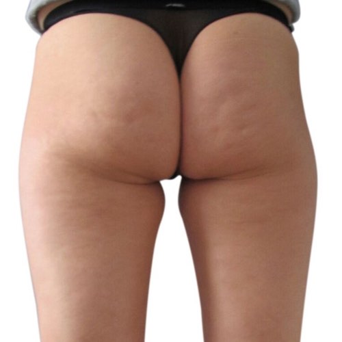 cellulite_4_before.jpg