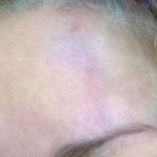 skin_resurfacing_1_after.jpg