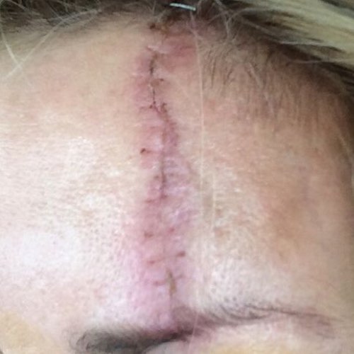 skin_resurfacing_1_before.jpg